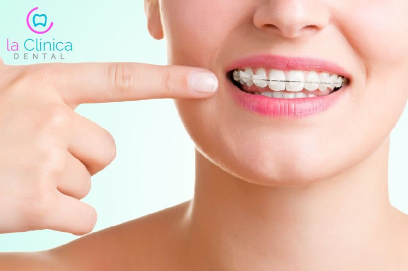 La Capital Ventajas Y Desventajas De Usar Brackets Como Saber Cuales