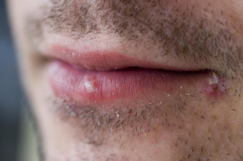 La Capital Herpes Labial Es Frecuente En Temporada Invernal IMSS